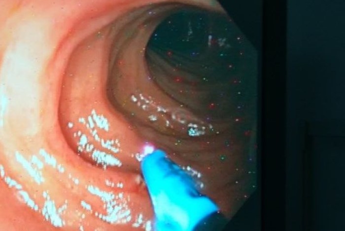 Endoscopia terapéutica Terapia con argón plasma